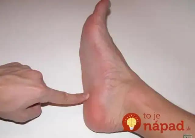 Kurie oko zmizlo bez vypaľovania a nohy mám hebké ako bábätko: Najrýchlejšia pomoc a funguje aj na bradavice!