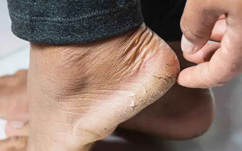 Mám 45 rokov a už ma konečne netrápia POPRASKANÉ PÄTY: Pomohol mi babkin zázračný domáci recept!