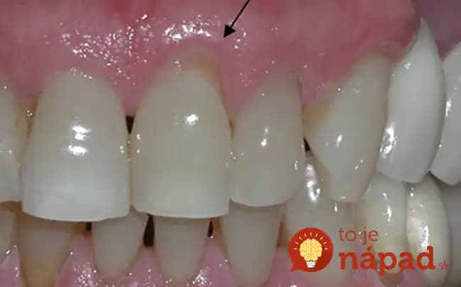 Trápia vás ustupujúce a boľavé ďasná? Toto dokáže pomôcť hneď! Na účinok nemá ani drahá zubná pasta!